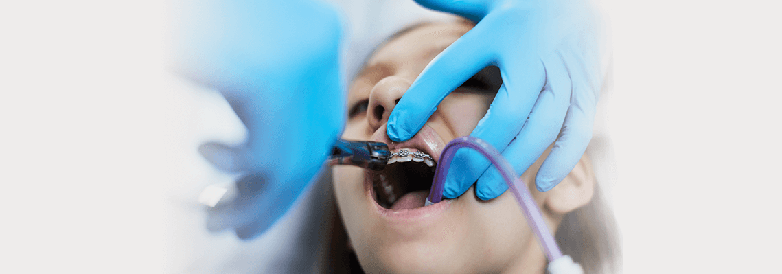 14-Must-Ask-Questions-During-The-Braces-Removal
