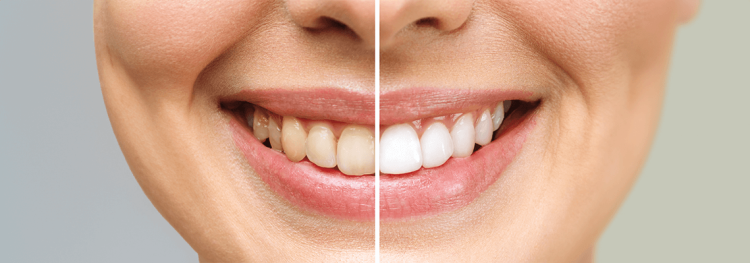 A-Comprehensive-Guide-To-Teeth-Whitening-Cost-In-Australia