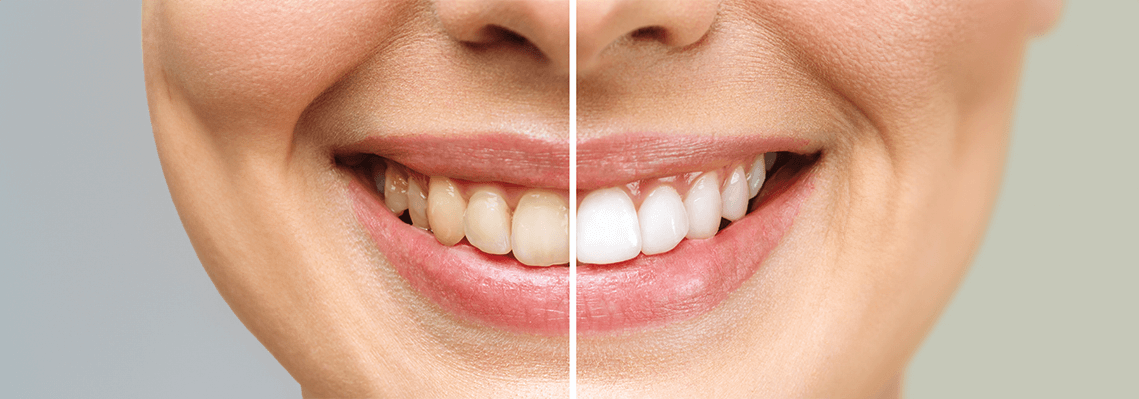 A-Comprehensive-Guide-To-Teeth-Whitening-Cost-In-Australia