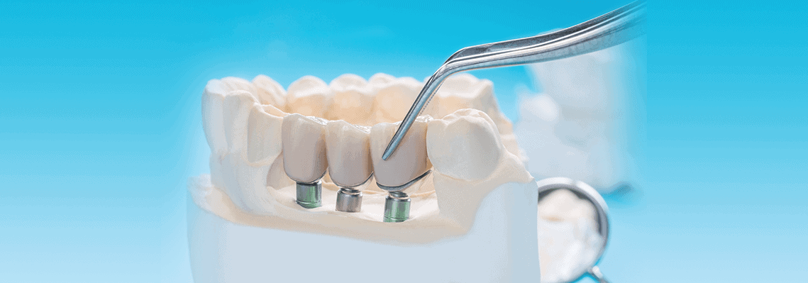 A-Detailed-Comparison-Between-All-on-4-&-Traditional-Dental-Implants