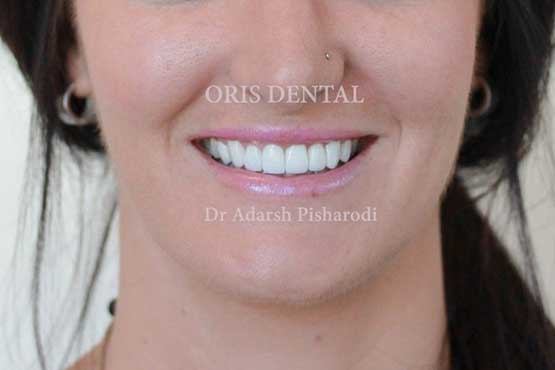 Smile Makeover Gallery 12 After-Front-3