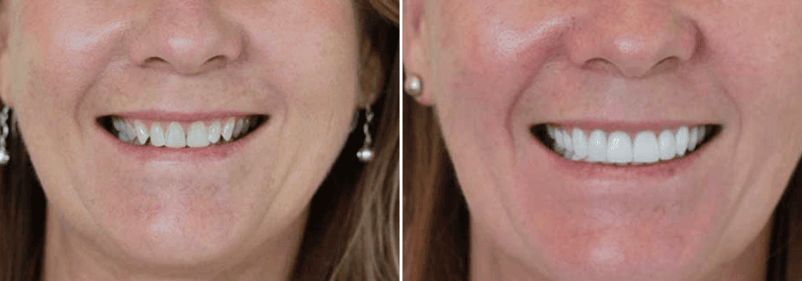 Before-And-After-Photos-Of-Dental-Procedures-Performed-By-Best-Cosmetic-Dentists-In-The-Sunshine-Coast