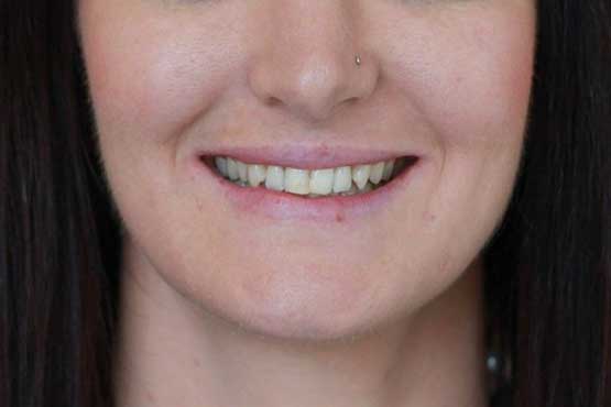 Smile Makeover Gallery 11 Before-Front-3