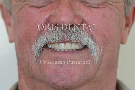 Smile Makeover Gallery 44 Before-and-After-JB-A