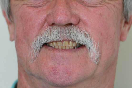 Smile Makeover Gallery 43 Before-and-After-JB-B