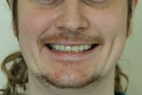 Smile Makeover Gallery 50 Before-and-After-JB1-A