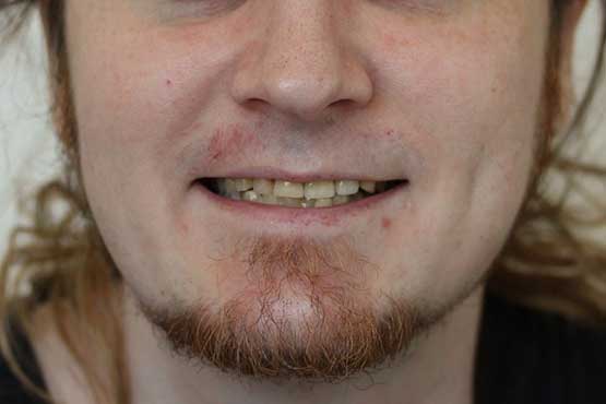 Smile Makeover Gallery 49 Before-and-After-JB1-B