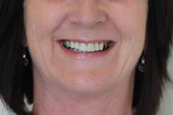 Smile Makeover Gallery 39 Before-and-After-KS-1