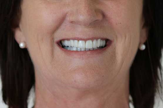 Smile Makeover Gallery 40 Before-and-After-KS-2