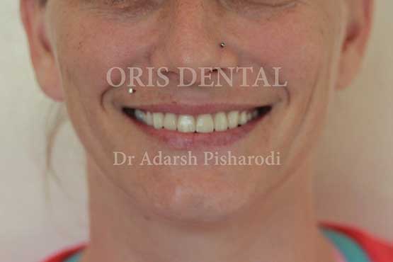 Smile Makeover Gallery 42 Before-and-After-MWA