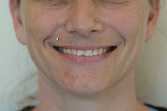 Smile Makeover Gallery 41 Before-and-After-MWB