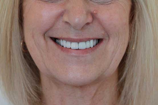 Smile Makeover Gallery 46 Before-and-After-NP-A