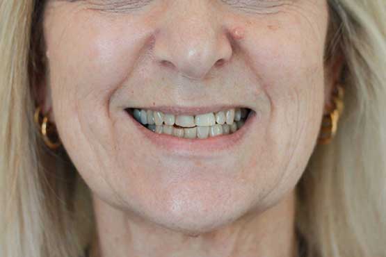 Smile Makeover Gallery 45 Before-and-After-NP-B