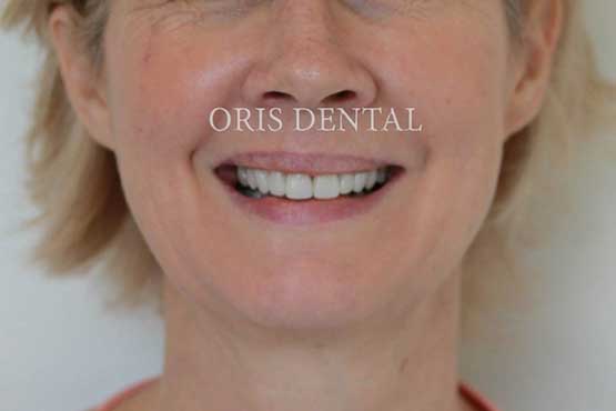 Smile Makeover Gallery 48 Before-and-After-NP1-A