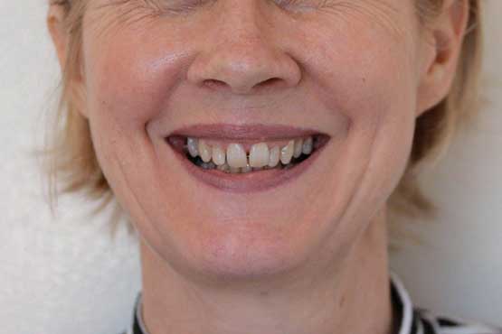 Smile Makeover Gallery 47 Before-and-After-NP1-B