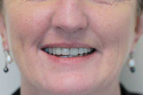 Smile Makeover Gallery 52 Before-and-After1-A