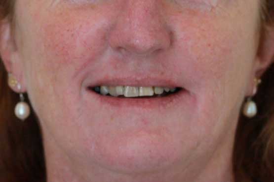 Smile Makeover Gallery 51 Before-and-After1-B