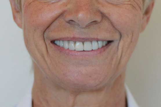 Smile Makeover Gallery 54 Before-and-After2-A