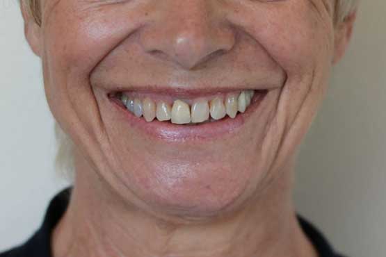 Smile Makeover Gallery 53 Before-and-After2-B