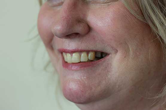 Smile Makeover Gallery 7 Before-side-A2