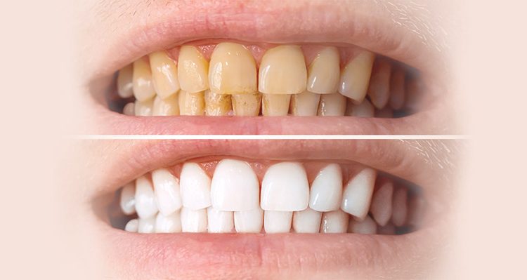 Types and Causes of Tooth Discolouration