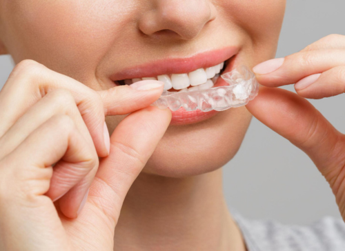 Clear Aligners For Teeth A Modern Approach To A Perfect Smile