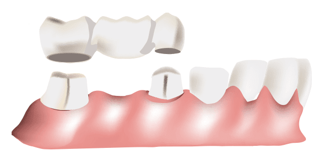 Dental Bridges
