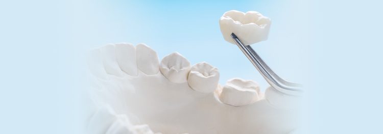 Dental crown vs filling treatment comparison