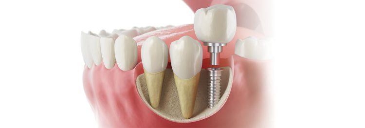 Dental Implant Before and After