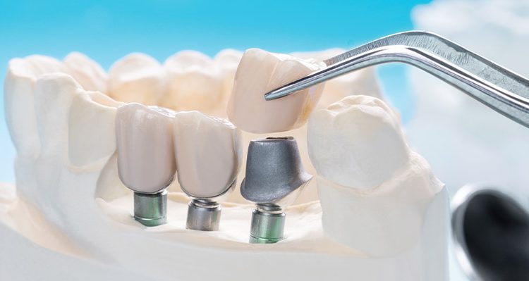 Dental Implants vs Bridges Comparison
