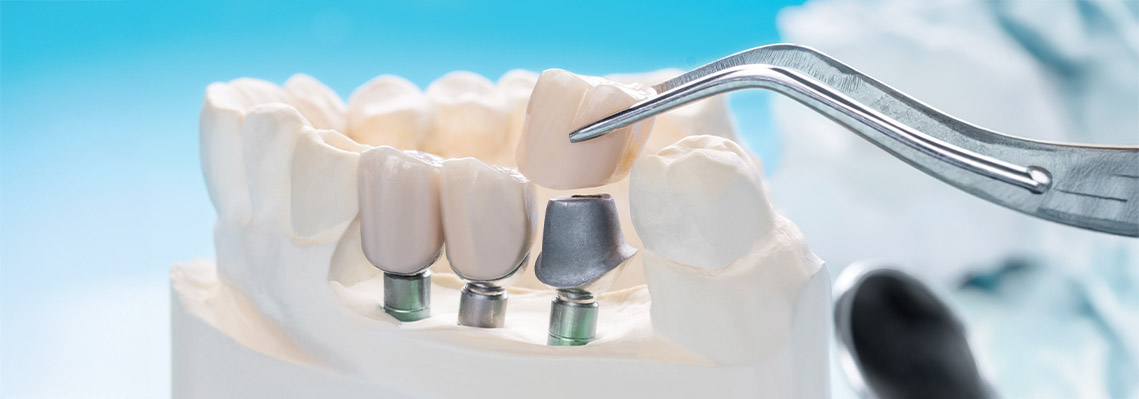 Dental Implants vs Bridges Comparison