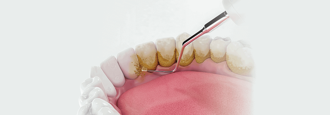 Dental-Plaque-and-Tartar--Causes-Preventio,-and-Removal