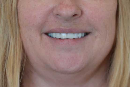 Smile Makeover Gallery 24 Enhanced-(5-Shades-Lighter)A