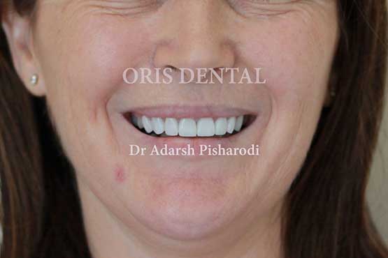 Smile Makeover Gallery 28 Enhanced-(5-Shades-Lighter)A1