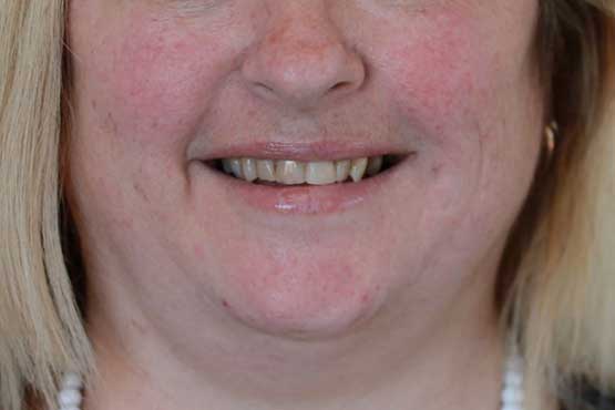 Smile Makeover Gallery 23 Enhanced-(5-Shades-Lighter)B