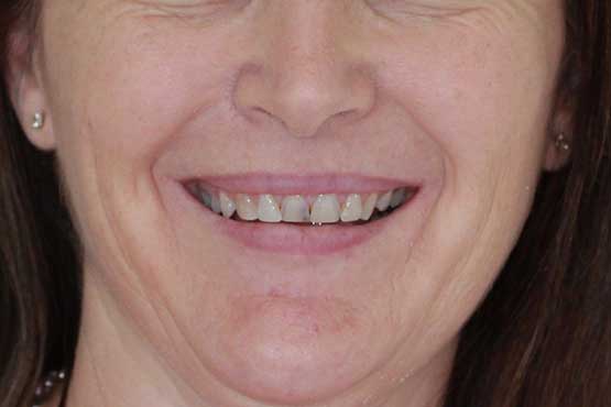 Smile Makeover Gallery 27 Enhanced-(5-Shades-Lighter)B1