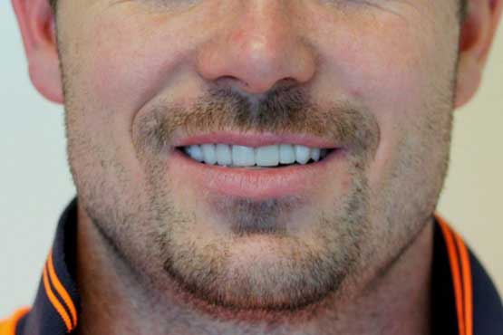 Smile Makeover Gallery 22 Enhanced-(6-Shades-Lighter)A