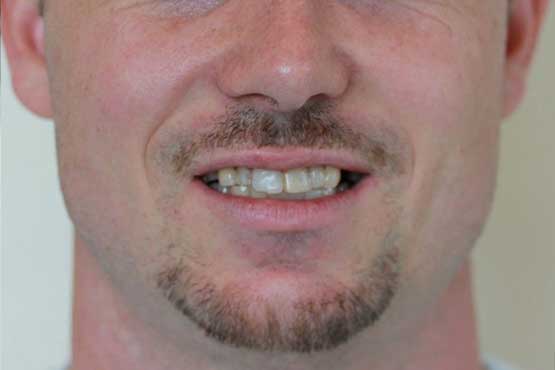 Smile Makeover Gallery 21 Enhanced-(6-Shades-Lighter)B