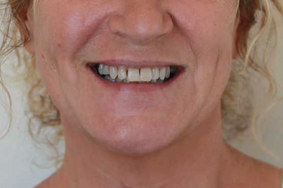 Smile Makeover Gallery 25 Enhanced-(7-Shades-Lighter)
