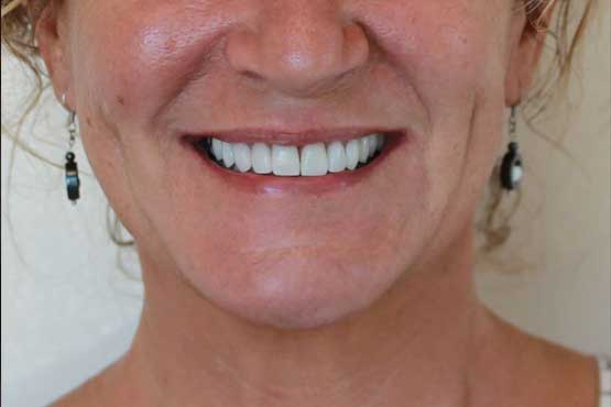 Smile Makeover Gallery 26 Enhanced-(7-Shades-Lighter)A