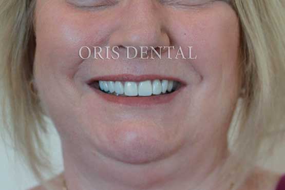 Smile Makeover Gallery 20 Enhanced-(8-Shades-Lighter)A