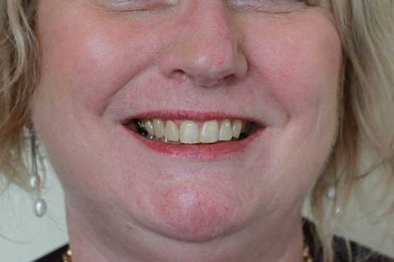 Smile Makeover Gallery 19 Enhanced-(8-Shades-Lighter)B