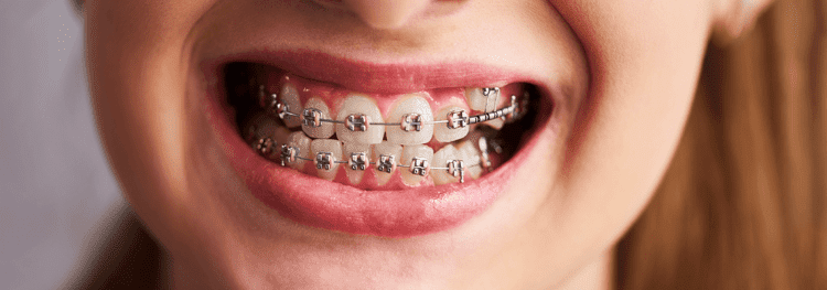 Gingivitis-and-Braces-Signs-Causes-and-Prevention