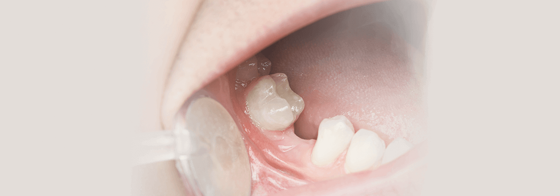 Hypodontia-Causes-and-Treatment-for-Congenitally-Missing-Teeth