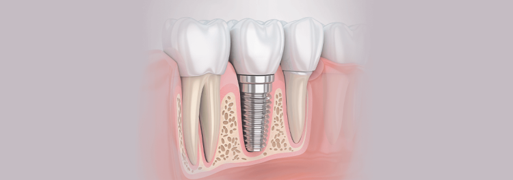 Impact-of-Dental-Implants-on-Improving-Your-Oral-Health
