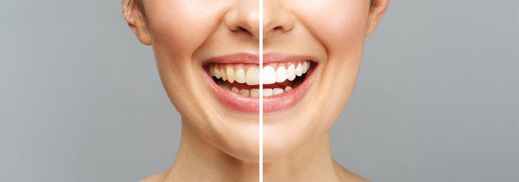 in-office vs at-home whitening