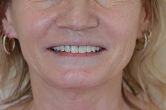 Smile Makeover Gallery 34 Natural-(-2-shades-lighter)A