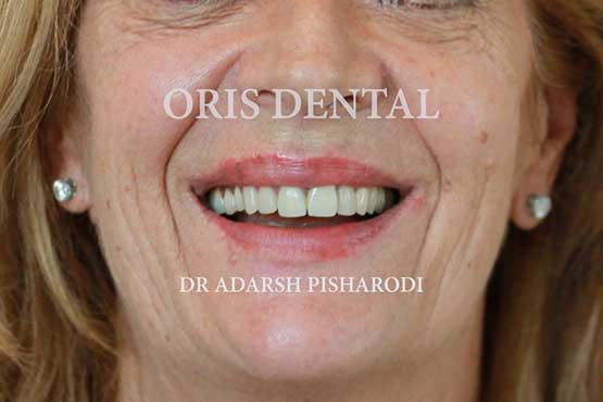 Smile Makeover Gallery 32 Natural-(-2-shades-lighter)A1