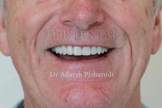 Smile Makeover Gallery 36 Natural-(-2-shades-lighter)A2