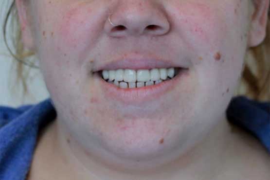 Smile Makeover Gallery 38 Natural-(-2-shades-lighter)A3